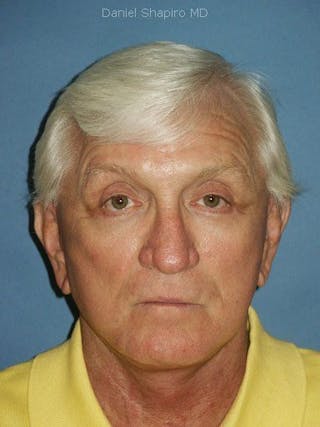 Male Facial Rejuvenation Before & After Gallery - Patient 17344028 - Image 2