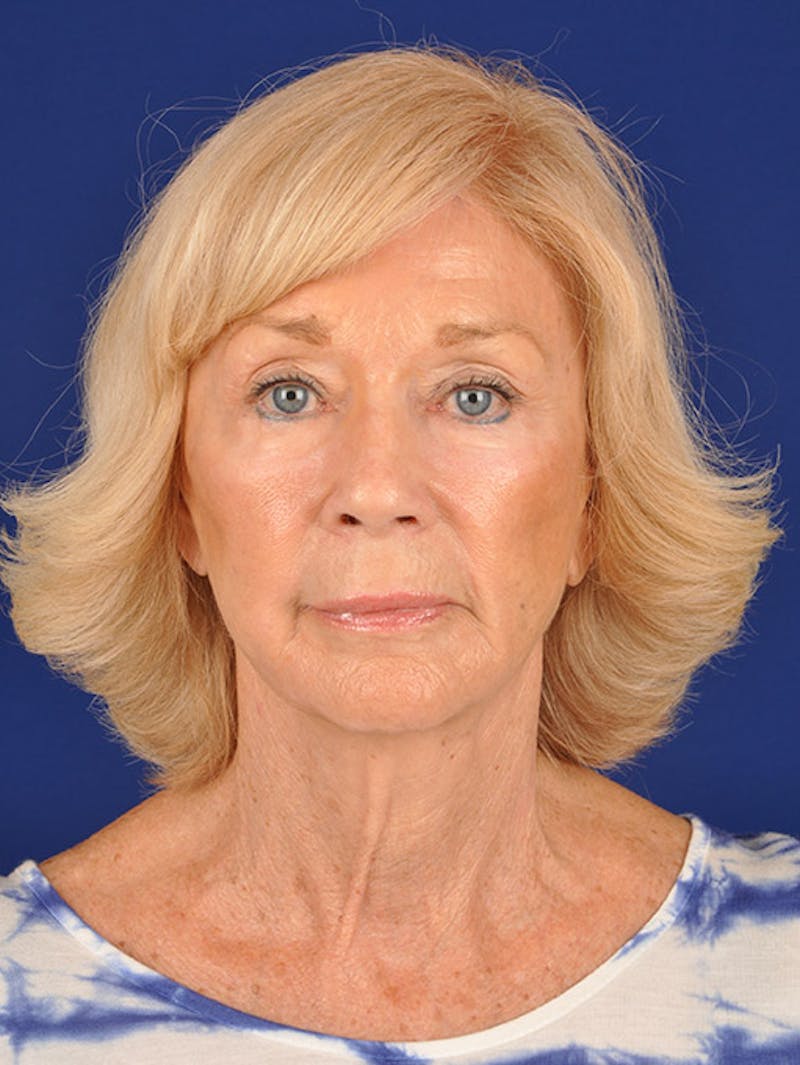 Mini Facelift Before & After Gallery - Patient 17344030 - Image 2