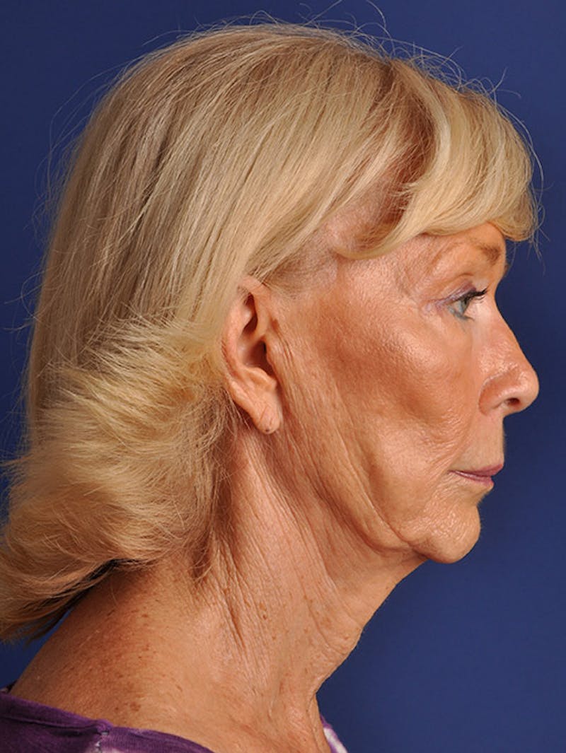 Mini Facelift Before & After Gallery - Patient 17344030 - Image 5