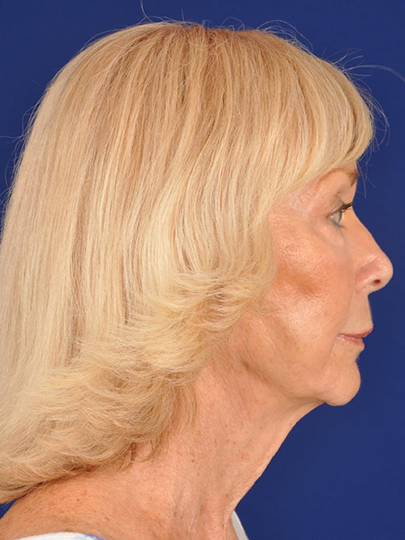 Mini Facelift Before & After Gallery - Patient 17344030 - Image 6