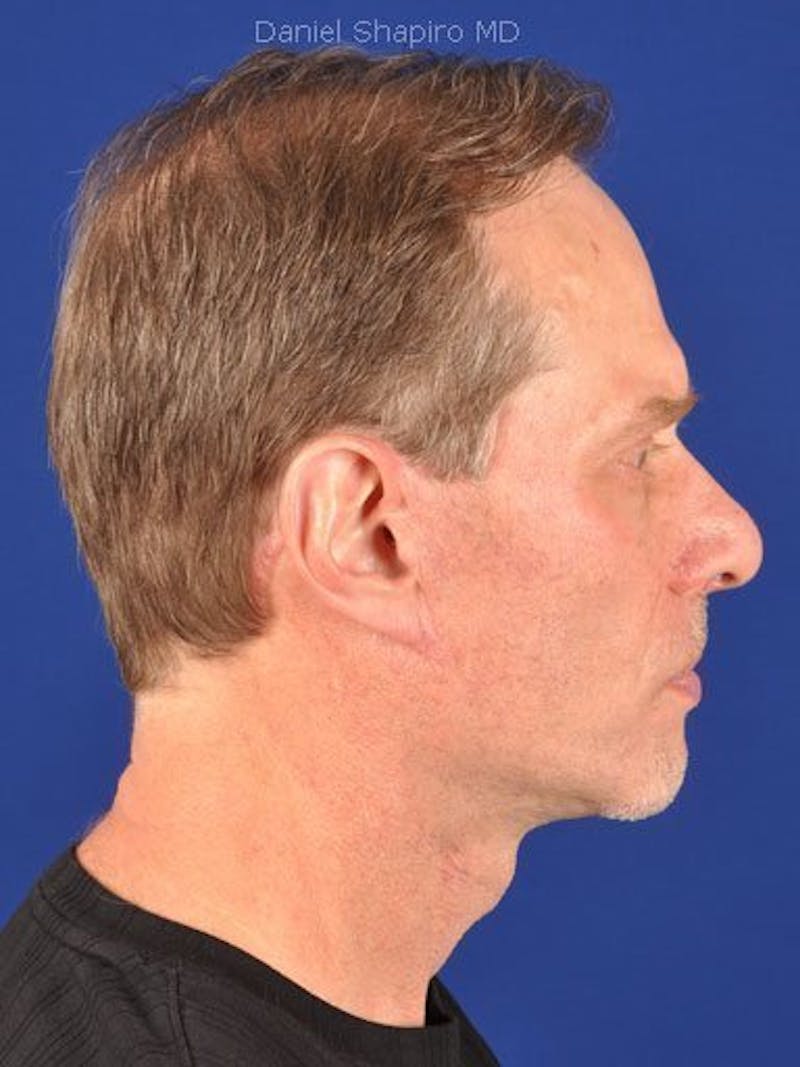 Male Facial Rejuvenation Before & After Gallery - Patient 17344031 - Image 6