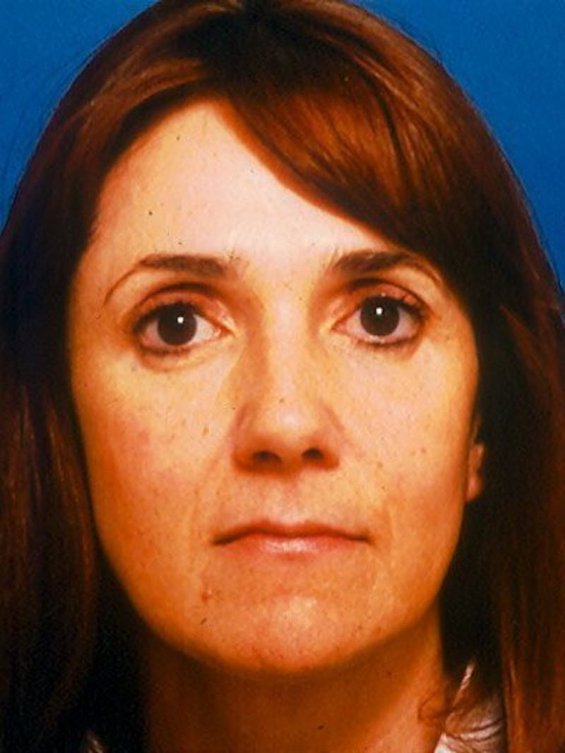 Mini Facelift Before & After Gallery - Patient 17344032 - Image 1