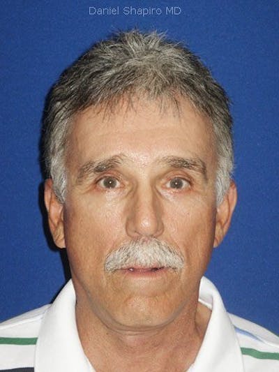 Male Facial Rejuvenation Before & After Gallery - Patient 17344034 - Image 2