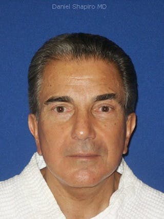 Male Facial Rejuvenation Before & After Gallery - Patient 17344036 - Image 2