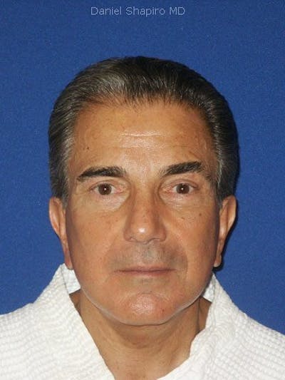 Male Facial Rejuvenation Before & After Gallery - Patient 17344036 - Image 2