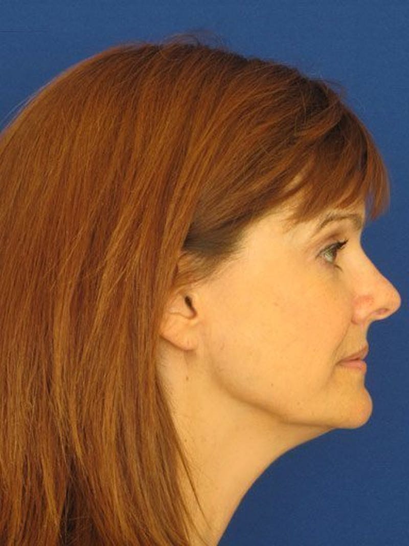 Mini Facelift Before & After Gallery - Patient 17344035 - Image 3