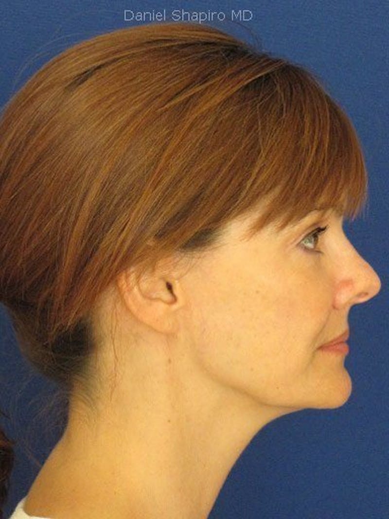 Mini Facelift Before & After Gallery - Patient 17344035 - Image 4