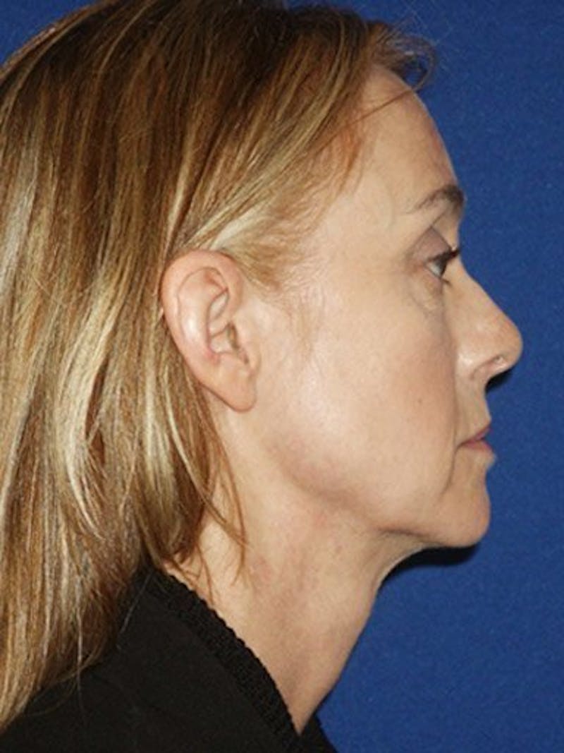 Mini Facelift Before & After Gallery - Patient 17344038 - Image 3