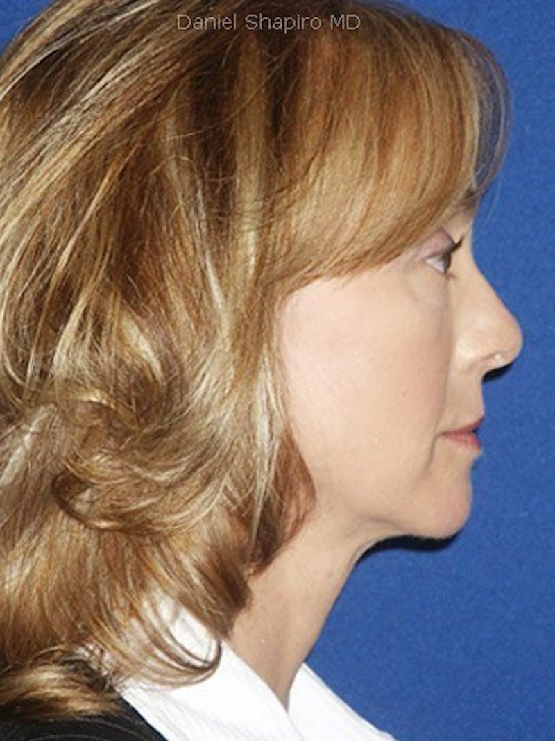 Mini Facelift Before & After Gallery - Patient 17344038 - Image 4