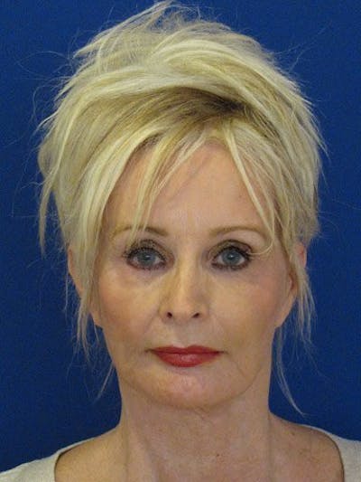 Mini Facelift Before & After Gallery - Patient 17344040 - Image 1