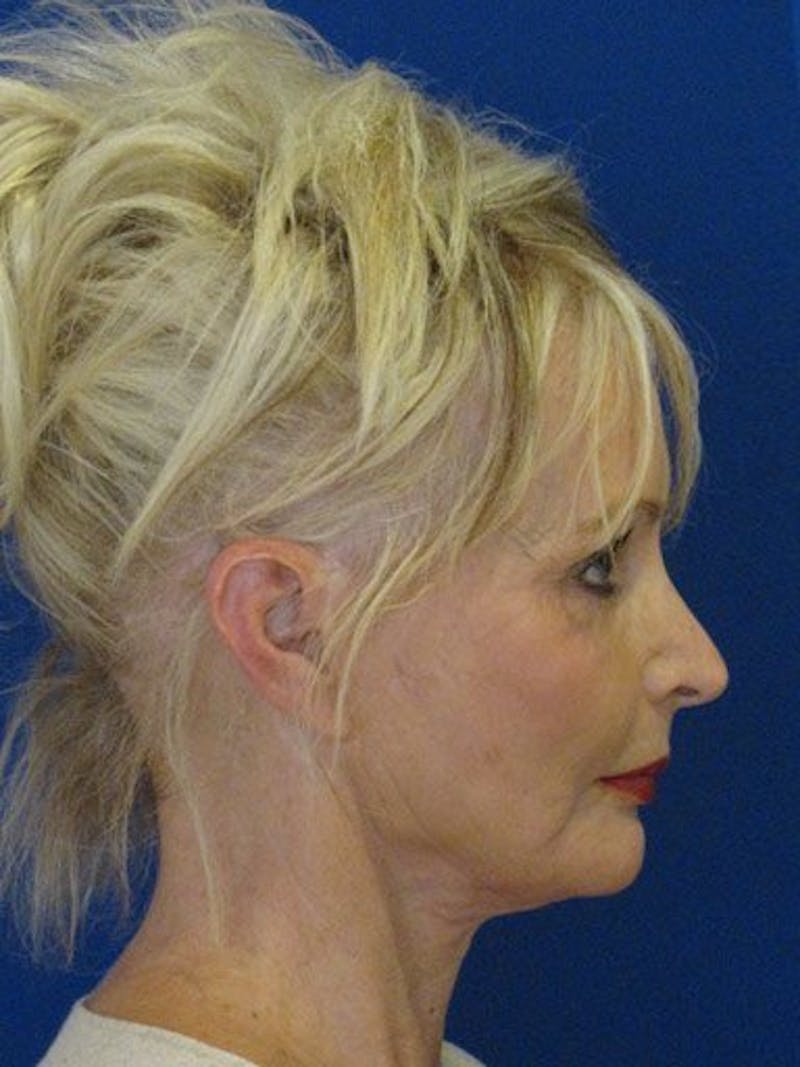 Mini Facelift Before & After Gallery - Patient 17344040 - Image 3