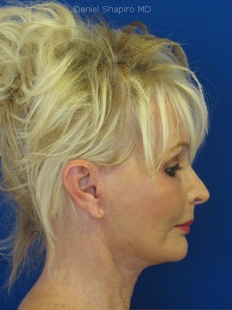 Mini Facelift Before & After Gallery - Patient 17344040 - Image 4