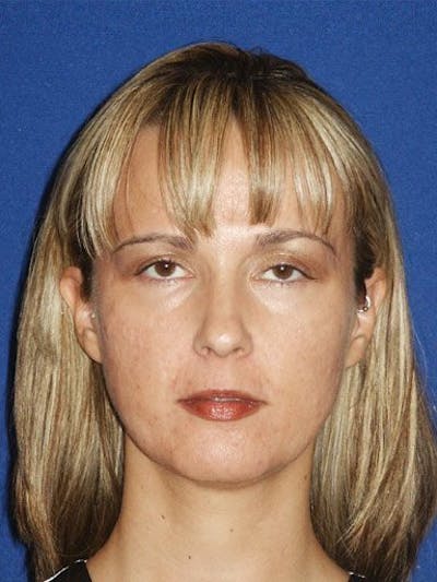 Mini Facelift Before & After Gallery - Patient 17344043 - Image 1