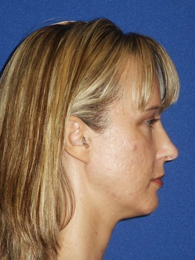 Mini Facelift Before & After Gallery - Patient 17344043 - Image 3