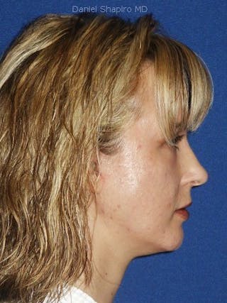 Mini Facelift Before & After Gallery - Patient 17344043 - Image 4