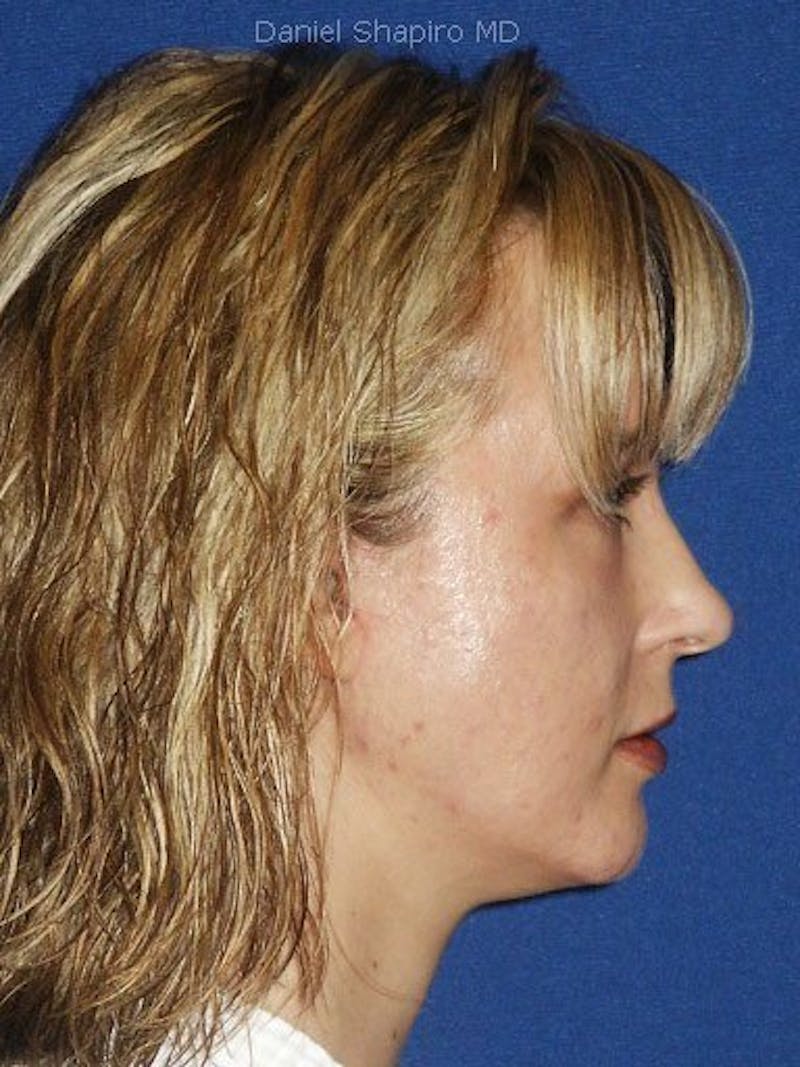 Mini Facelift Before & After Gallery - Patient 17344043 - Image 4