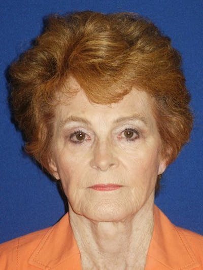 Mini Facelift Before & After Gallery - Patient 17344047 - Image 1