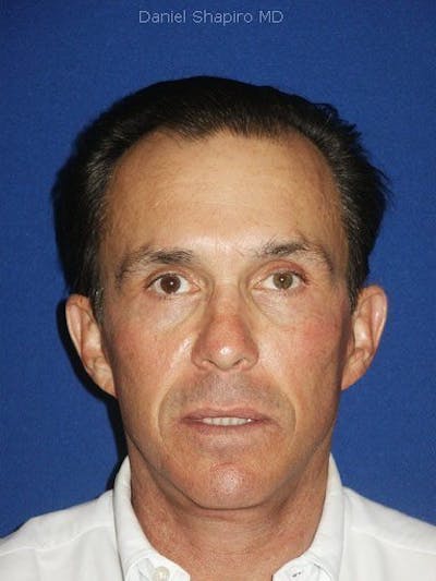 Male Facial Rejuvenation Before & After Gallery - Patient 17344048 - Image 2