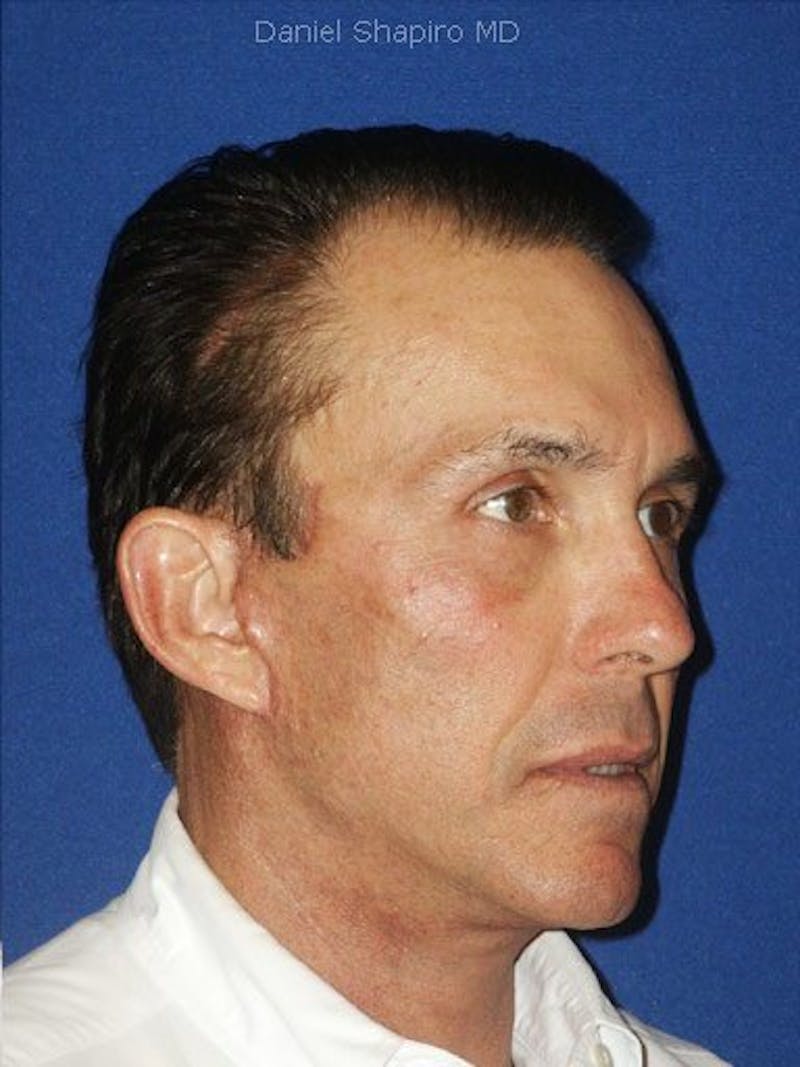 Facial Rejuvenation Before & After Gallery - Patient 18264926 - Image 4