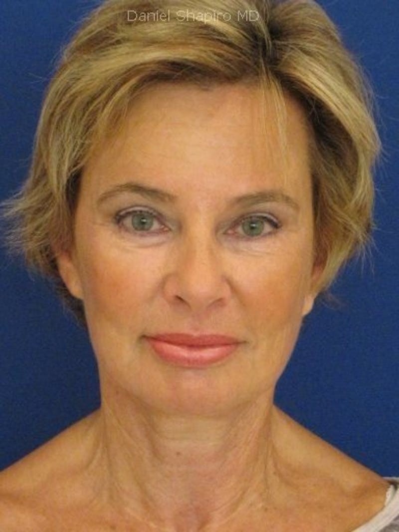 Mini Facelift Before & After Gallery - Patient 17344049 - Image 2