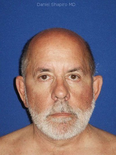 Male Facial Rejuvenation Before & After Gallery - Patient 17344050 - Image 2