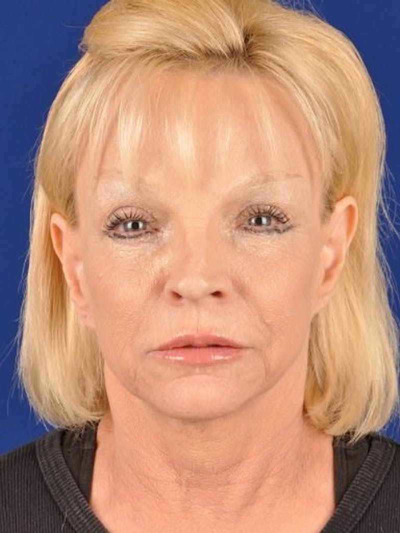 Mini Facelift Before & After Gallery - Patient 17344051 - Image 1