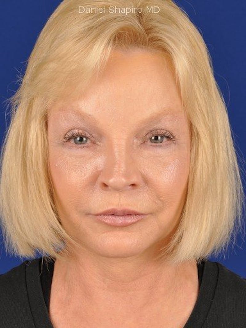 Mini Facelift Before & After Gallery - Patient 17344051 - Image 2
