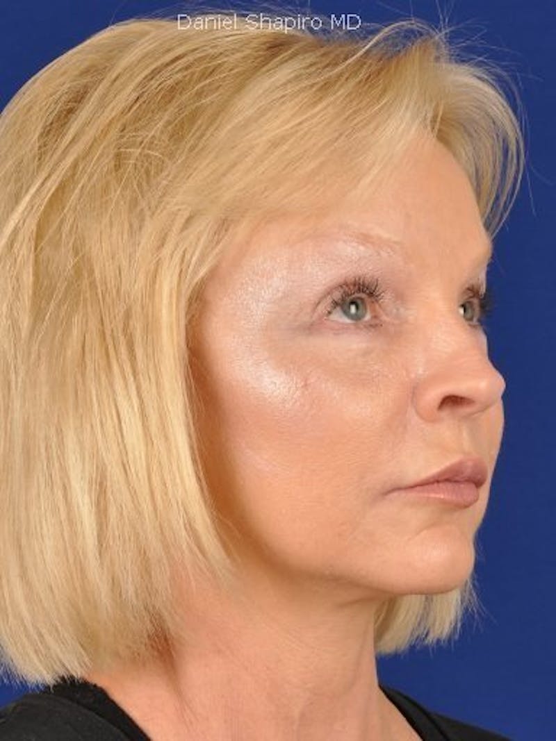 Mini Facelift Before & After Gallery - Patient 17344051 - Image 4