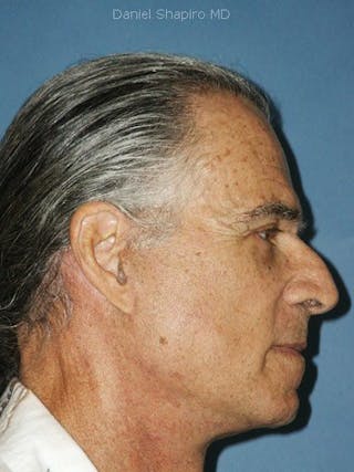 Facial Rejuvenation Before & After Gallery - Patient 18264928 - Image 4