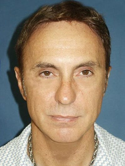 Facial Rejuvenation Before & After Gallery - Patient 18264929 - Image 1
