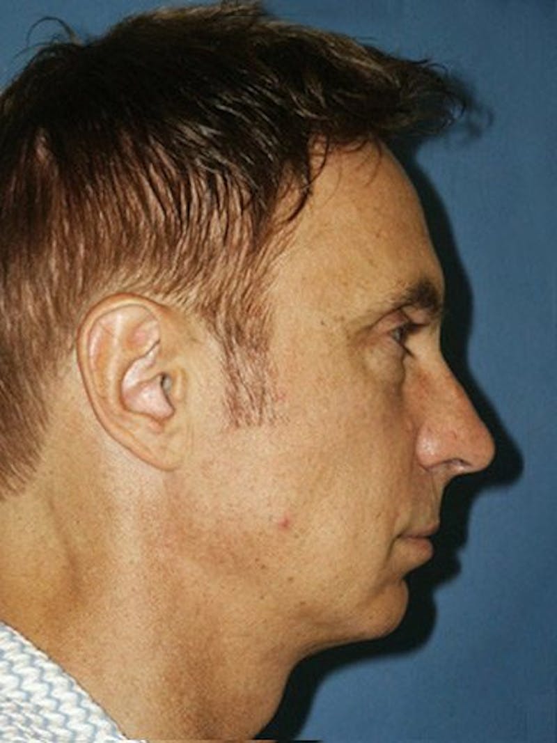 Facial Rejuvenation Before & After Gallery - Patient 18264929 - Image 3