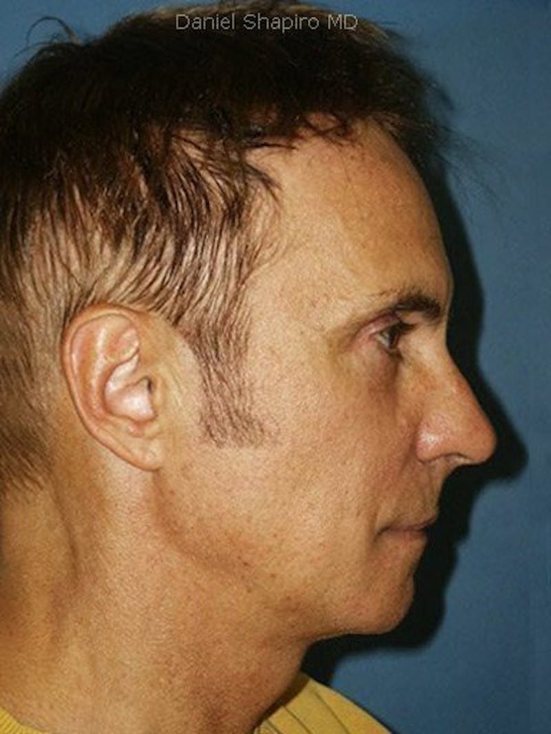 Male Facial Rejuvenation Before & After Gallery - Patient 17344058 - Image 4