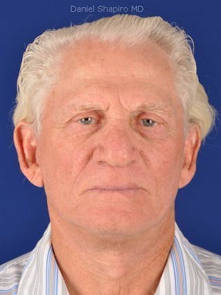 Facial Rejuvenation Before & After Gallery - Patient 18264934 - Image 2