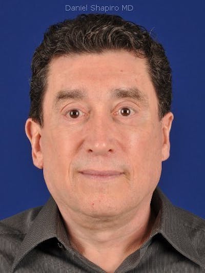 Facial Rejuvenation Before & After Gallery - Patient 18264935 - Image 2