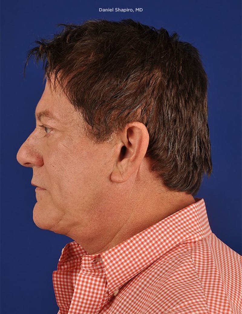 Male Facial Rejuvenation Before & After Gallery - Patient 17344070 - Image 5