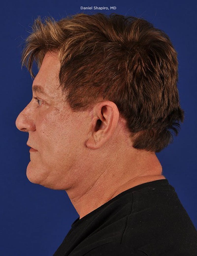 Male Facial Rejuvenation Before & After Gallery - Patient 17344070 - Image 6