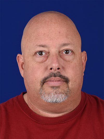 Facial Rejuvenation Before & After Gallery - Patient 18264938 - Image 1