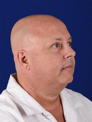 Facial Rejuvenation Before & After Gallery - Patient 18264938 - Image 4