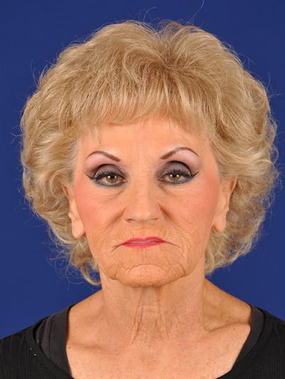 GenX Lift Before & After Gallery - Patient 17344087 - Image 1