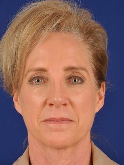 GenX Lift Before & After Gallery - Patient 17344091 - Image 1