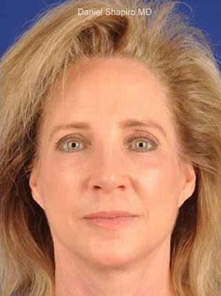 GenX Lift Before & After Gallery - Patient 17344091 - Image 2