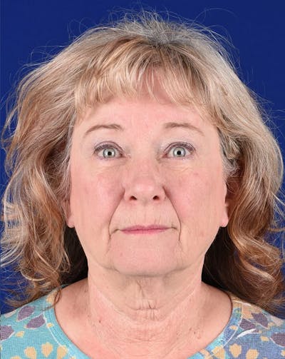 Brow Lift Before & After Gallery - Patient 17344096 - Image 2