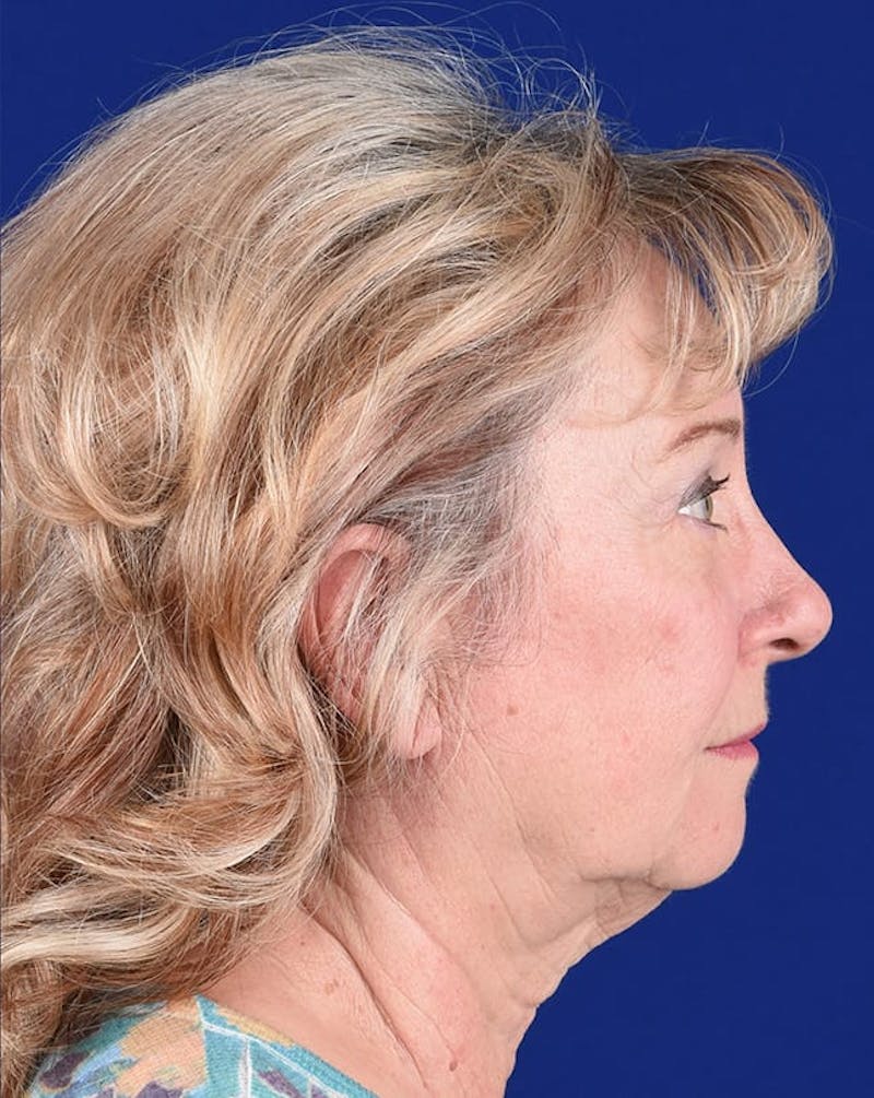 Brow Lift Before & After Gallery - Patient 17344096 - Image 6