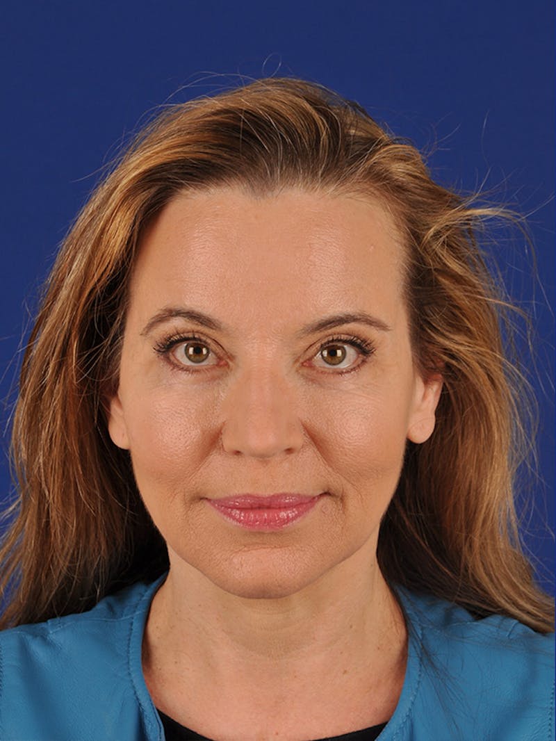 Brow Lift