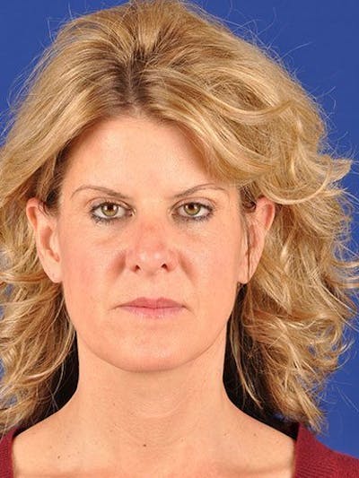 GenX Lift Before & After Gallery - Patient 17344101 - Image 1