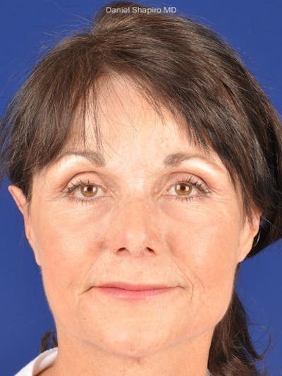 GenX Lift Before & After Gallery - Patient 17344107 - Image 2