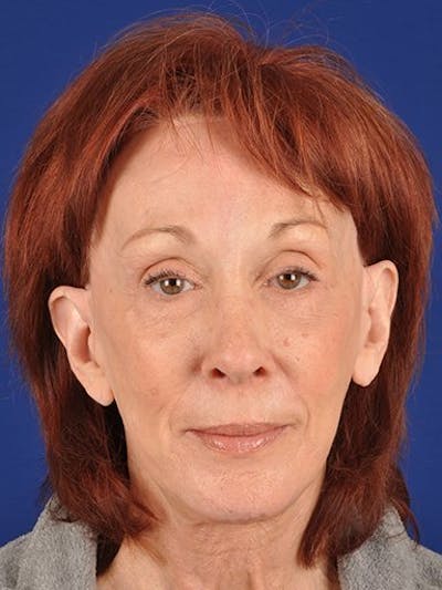 GenX Lift Before & After Gallery - Patient 17344110 - Image 1