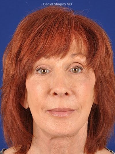 GenX Lift Before & After Gallery - Patient 17344110 - Image 2