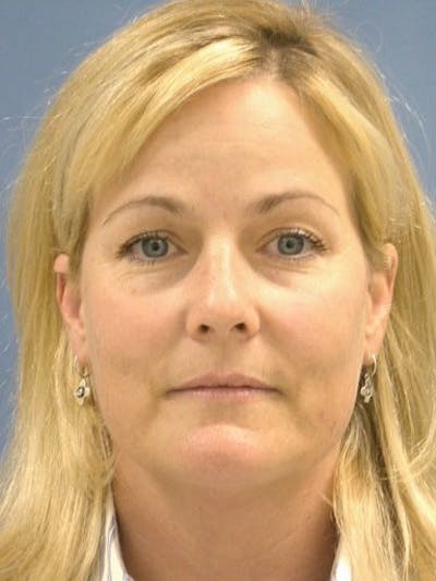 Brow Lift Before & After Gallery - Patient 17344111 - Image 1