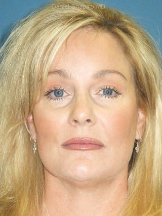 Brow Lift Before & After Gallery - Patient 17344111 - Image 2